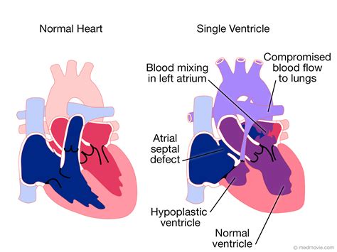 Hypoplastic Left Heart Syndrome