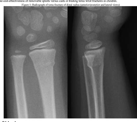 Buckle Fracture Wrist Splint
