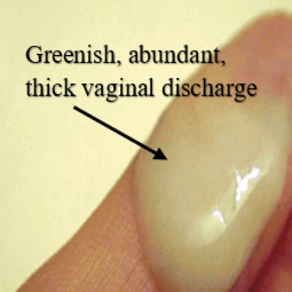 Bacterial Vaginosis Discharge In Women