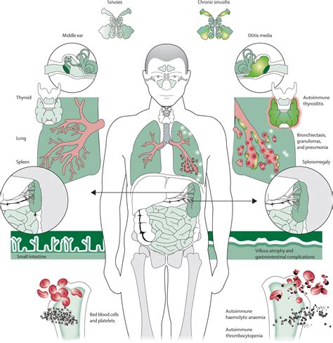 Common variable immunodeficiency: a new look at an old disease - The Lancet