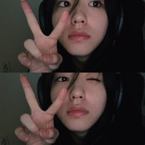 lupus x chromosome