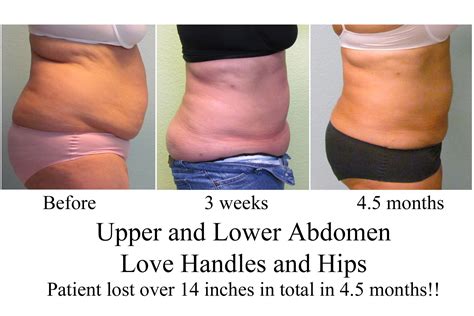 abdominal liposuction recovery - Liposuction - Vaser Lipo