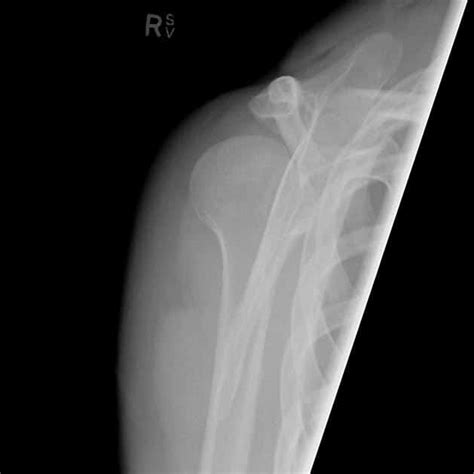 Image result for Posterior Shoulder Dislocation Sulcus Sign