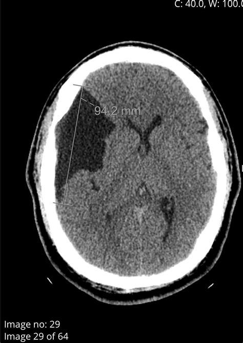 Incidental finding - Arachnoid cyst in brain : r/Radiology
