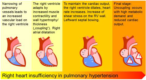 Diagnostics | Free Full-Text | Right Heart Size and Right Ventricular Reserve in Pulmonary ...