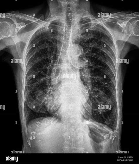 Chest X Ray Pneumonia Vs Bronchitis