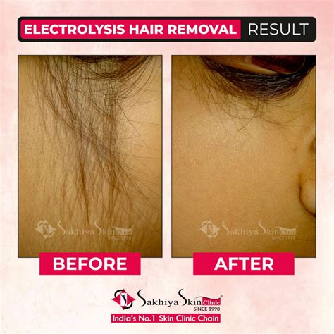 Electrolysis Hair Removal – Procedure, Benefits And Cost In India - Sakhiya Skin Clinic