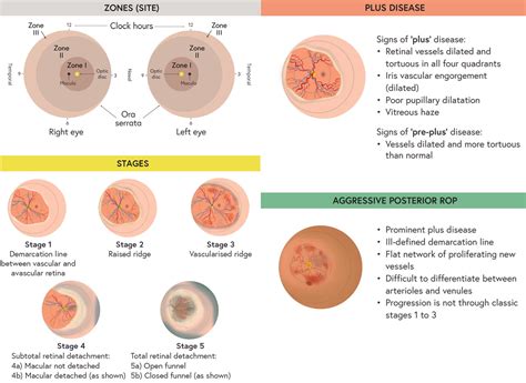 Retinopathy of Prematurity (ROP) - Ophtha.info