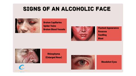 How To Spot An Alcoholic Face