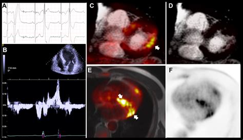 Arrhythmic Mitral Valve Prolapse With Only Mild or Moderate Mitral Regurgitation ...