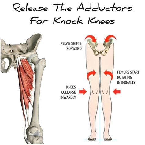 knock knees fix