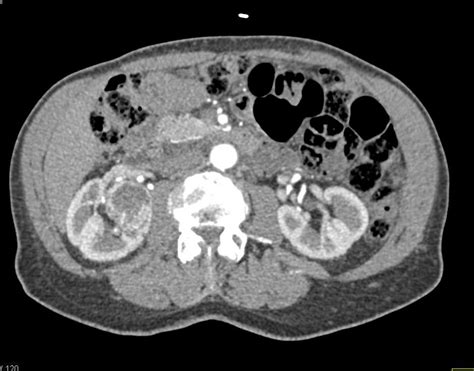 Kuvatulokset haulle parapelvic cyst kidney