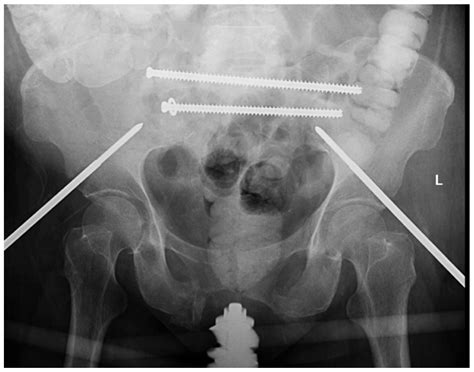 Surgical Techniques Development | Free Full-Text | Fixation of Sacral Ala Fracture Using a ...