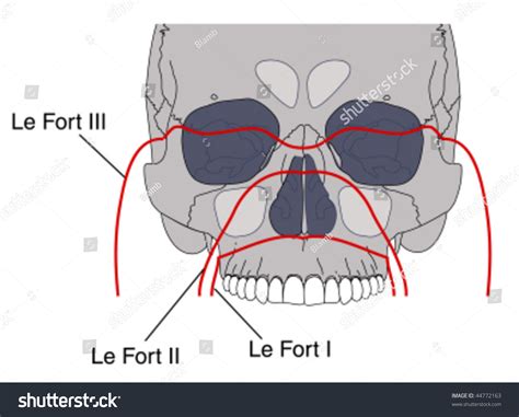 Le Fort Fracture
