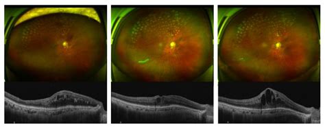Sustained Intraocular Pressure Control after iStent Infinite ...
