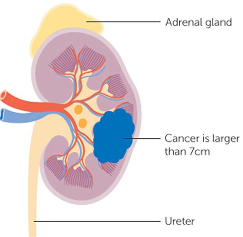 Kidney Cancer - Causes, Symptoms, Signs, Stages & Treatment