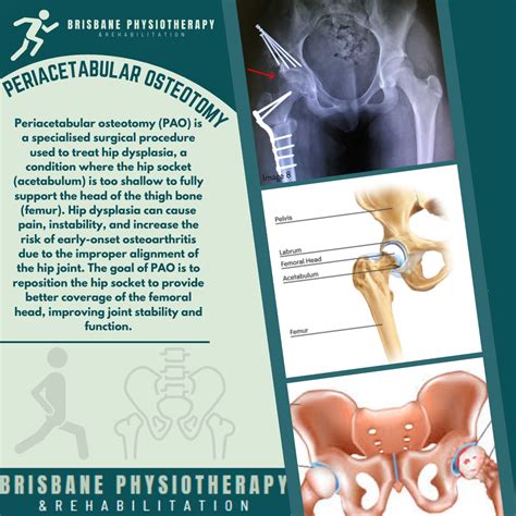 Periacetabular osteotomy (PAO) - Brisbane Physiotherapy & Podiatry
