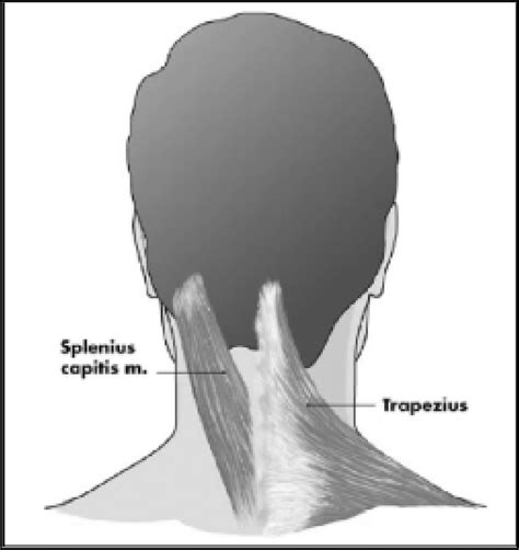 Splenius 的图像结果