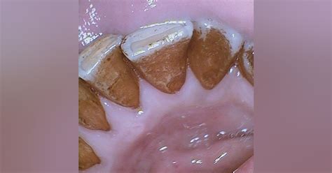 Image result for Tooth Stain