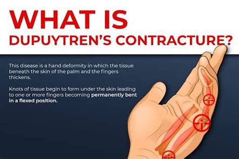 Dupuytren's contracture - MEDizzy