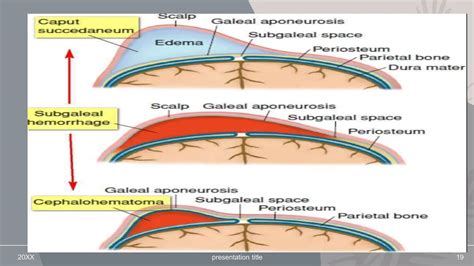 Cephalohematoma Vs Caput