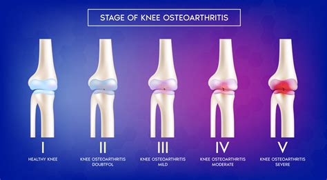 Knee Osteoarthritis - GulfPhysio - UAE's Online Physiotherapy Store