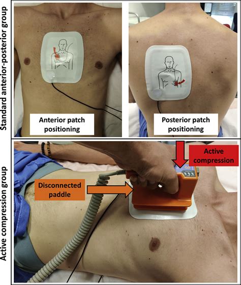 Defibrillation Versus Cardioversion at Jane Hankerson blog