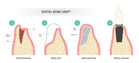 Bone Graft After Tooth Extraction