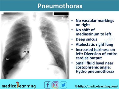 Left Pneumothorax X Ray