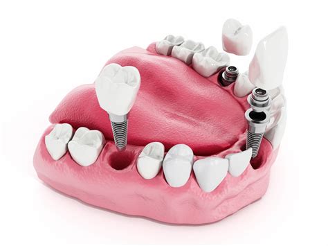 How Common is Infection After Dental Implants? | Hanna Dental Implant Center - dental implant images