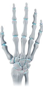 Handgelenksarthrose - Bort