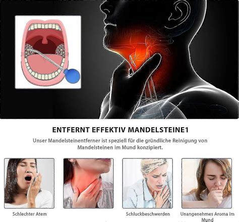 Tonsil Stone Remover, Tonsil Stone Removal Tool, Tonsil Stone Tonsilitis Halitosis Treatment ...