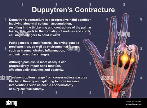 A 3D medical illustration displaying a patient's hand with Dupuytren's ...