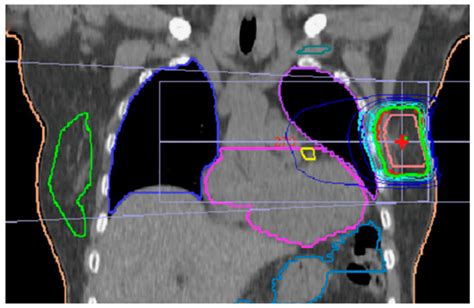 Cancers | Special Issue : Radiation Therapy for Breast Cancer: Recent ...
