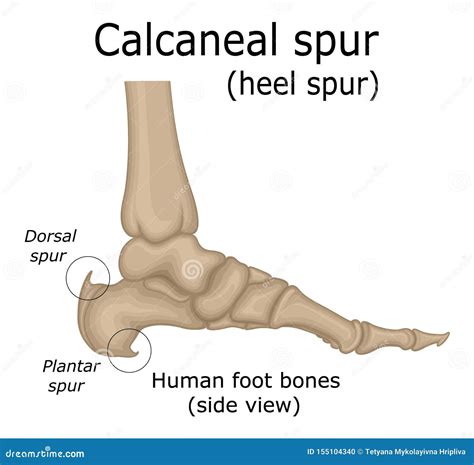 Bone Spur In Calcaneus