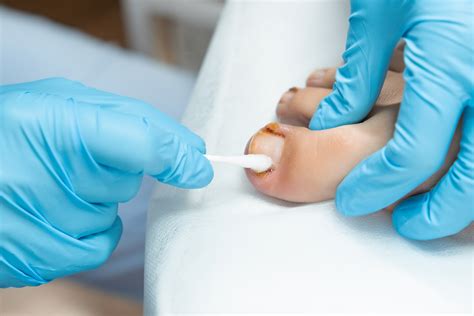 Thick Toenails: Causes, Home Remedies & Podiatric Care | The Foot Practice