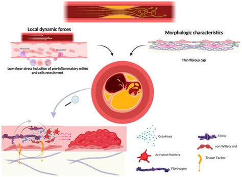 Molecular Pathways of Vulnerable Carotid Plaques at Risk of Ischemic ...