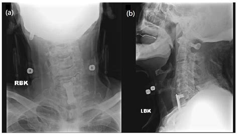 Guillain-Barré Syndrome with Respiratory Failure following Spine ...