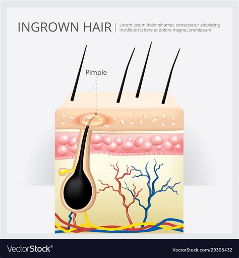 https://cdn3.vectorstock.com/i/1000x1000/54/32/ingrown-hair-structure-vector-29305432.jpg