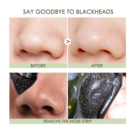 Blackheads Removal Strips