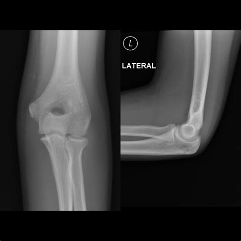 Elbow Fracture X Ray Signs at Anton Thomas blog