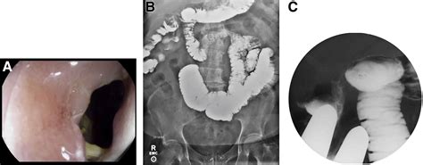 Profound Diarrhea After Cholecystectomy - Gastroenterology