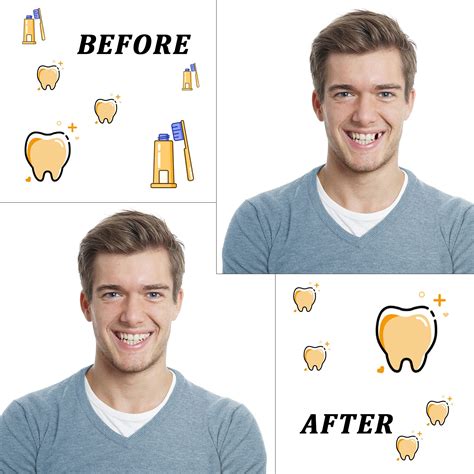 Resin Teeth Veneers Mixed Dental Temporary Teeth Front and Molar ...