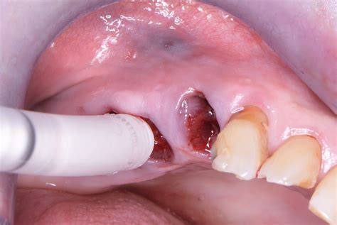 Open Healing Socket Preservation with and without Implant restoration. | Restore Surgical