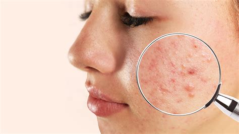 Dealing with different types of Acne | Acne Solutions | Acne Removal ...