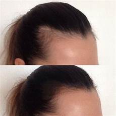 Baby Hair Fall Out Grow Back by Ramonamichelle Postpartum Hair Loss Baby Hair Fall Out Grow Back