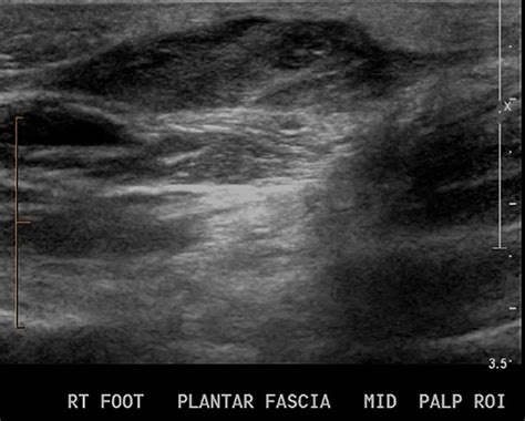 Fibromatosis types, causes, symptoms, diagnosis & treatment