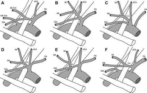 Embolization through the thyrocervical trunk: vascular anatomy, variants, and a case series ...