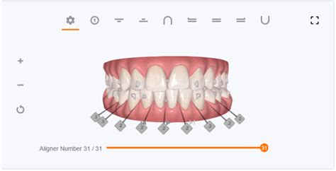 Image result for Invisalign ClinCheck