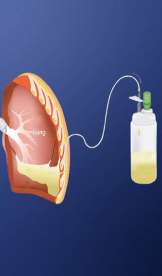 Pulmonologist in Faridabad | Lung Specialist in Faridabad